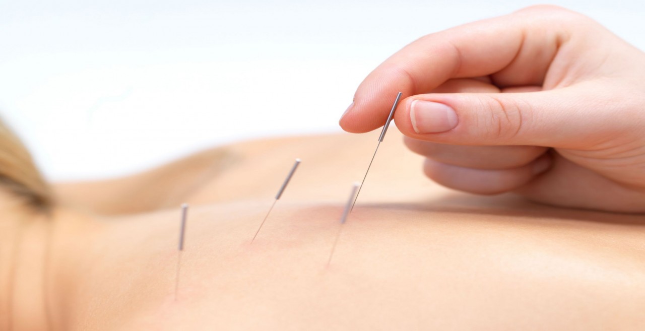 Acupuntura: picadas na pele, efeitos analgésicos