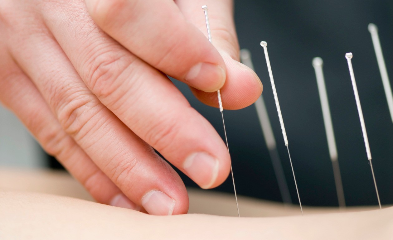 Acupuntura no tratamento da TPM